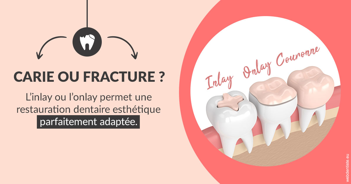 https://dr-bricout-anne-emmanuelle.chirurgiens-dentistes.fr/T2 2023 - Carie ou fracture 2
