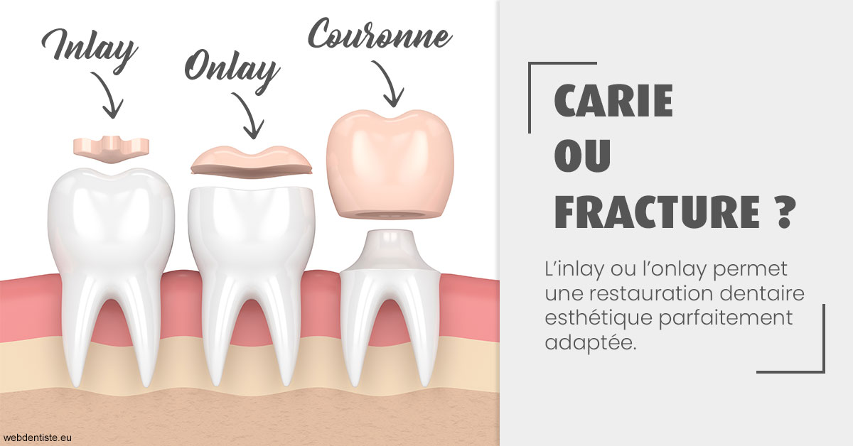 https://dr-bricout-anne-emmanuelle.chirurgiens-dentistes.fr/T2 2023 - Carie ou fracture 1