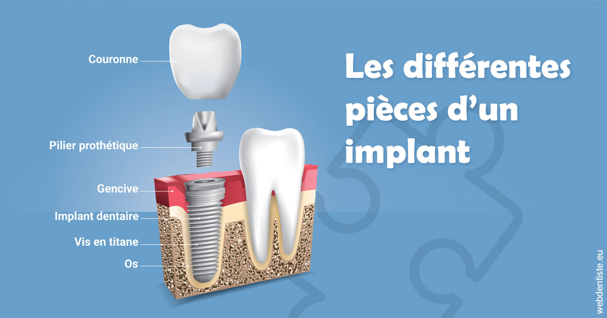 https://dr-bricout-anne-emmanuelle.chirurgiens-dentistes.fr/Les différentes pièces d’un implant 1
